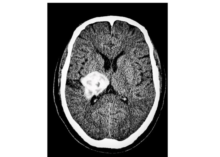 Researcher takes steps further in brain tumour treatment