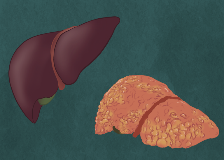 Breaking down liver disease